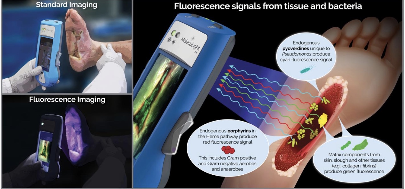 DIAGNOSTIC ACCURACY OF POINTOFCARE FLUORESCENCE IMAGING FOR THE